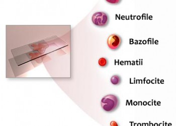 Creșterea eozinofilelor din sânge - Pericardită 