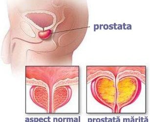 calcificări în erecția prostatei