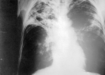 Prostata Tuberculoza - Pagini [1] - Lume cunoștințe enciclopedice