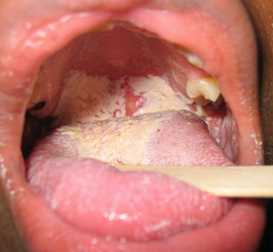 preparate orale pentru tratament comun